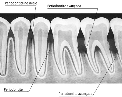 Doença Periodontal